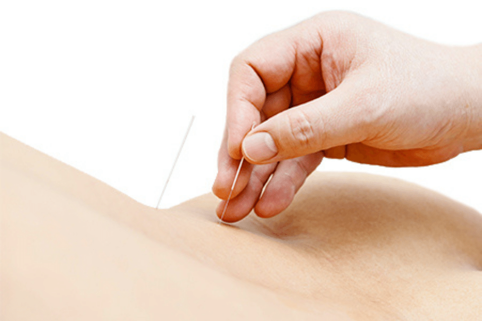 Can Acupuncture Treat IBS?
